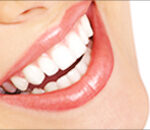 porcelain veneers