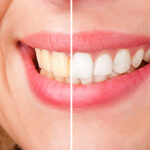 teeth whitening before and after