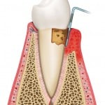 Gum Disease Treatment