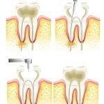 Root Canal